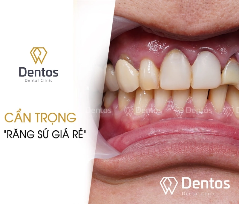 Lời cảnh tỉnh trước tác hại của làm răng sứ thẩm mỹ giá SIÊU rẻ